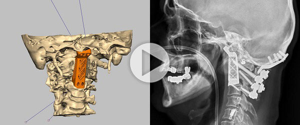 3D printed vertebrae