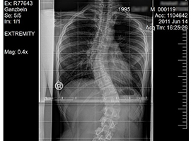 Scoliosis in a 15-year-old
